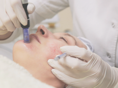 Explaining Micro-injury Skin Treatments To Your Clients